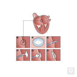 A medical illustration explaining the process of repairing a hole in the heart